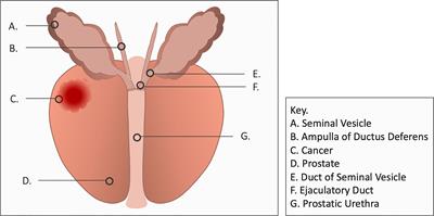 Bothersome Hematospermia Following Stereotactic Body Radiation Therapy for Prostate Cancer